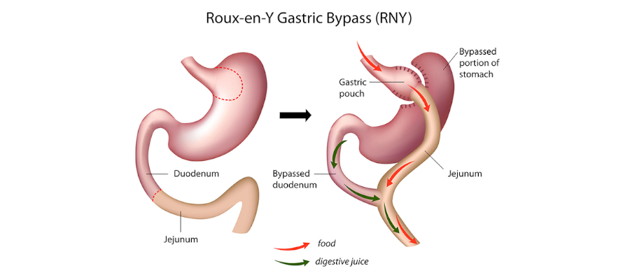 Magenbypass Operation (Magenbypass)