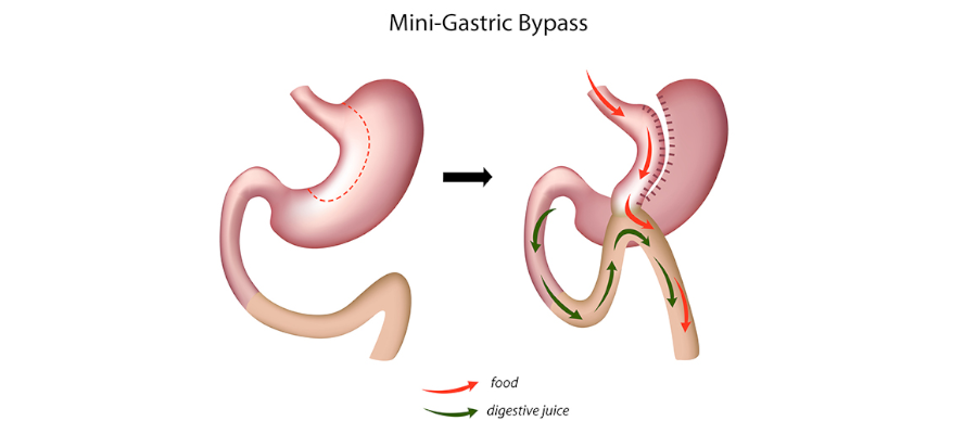 Mini Magenbypass Operation