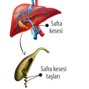 safra-kesesi-ameliyati-2