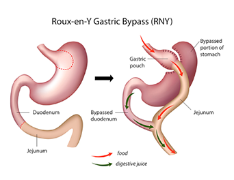 What is Gastric Bypass Procedure? How is it Performed?