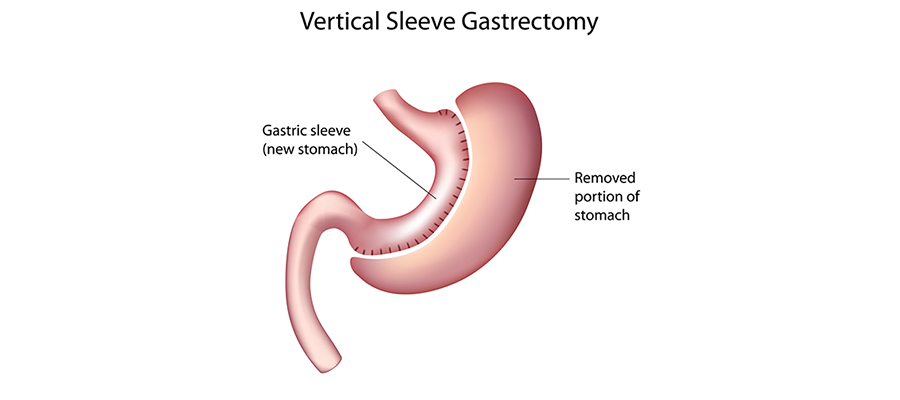 What is Sleeve Gastrectomy? How is it performed?