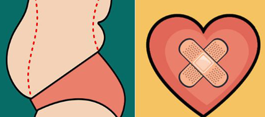 Can Bariatric Surgery Better Your Heart Health?
