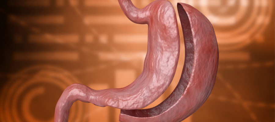 What is bariatric surgery?