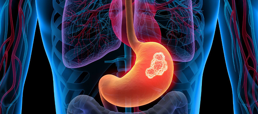 Stomach Cancer