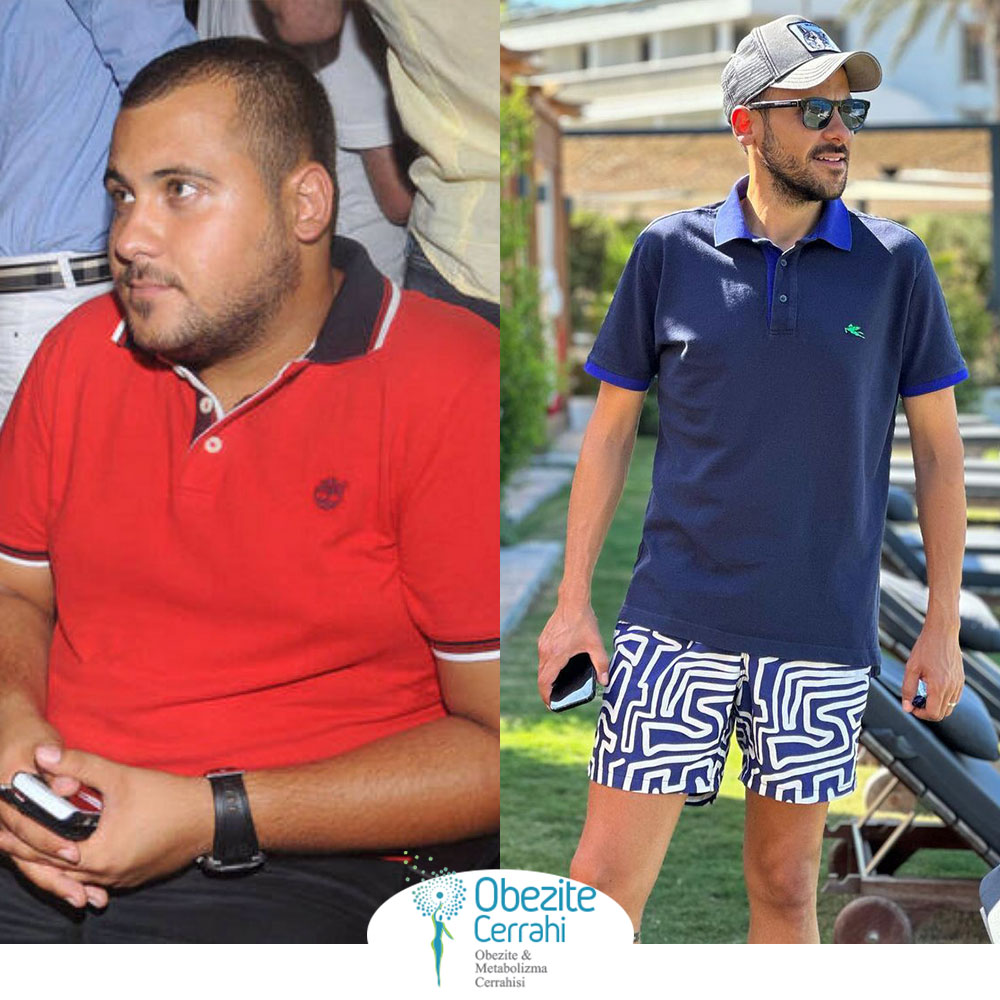 before-after