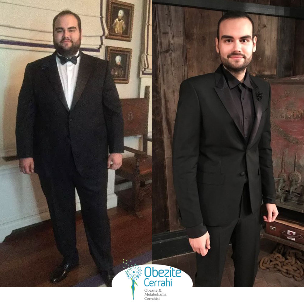before-after