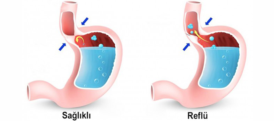 Reflü ve Tüp Mide