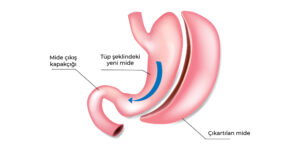 Tüp Mide Ameliyatı