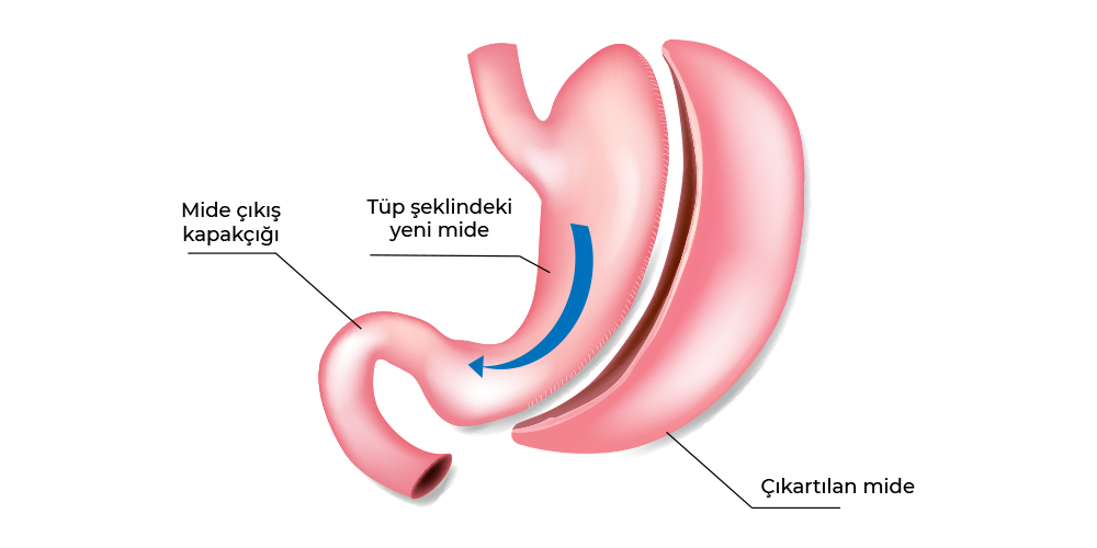 Tüp Mide Ameliyatı (Mide Küçültme Ameliyatı)